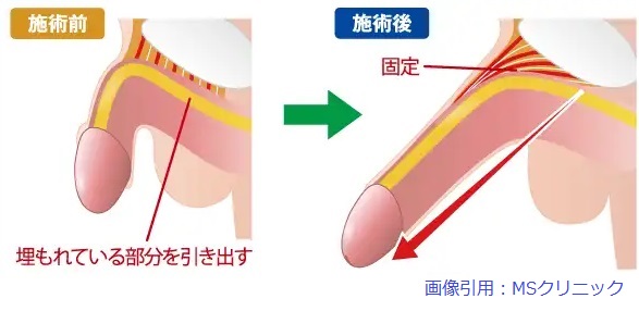 長茎術