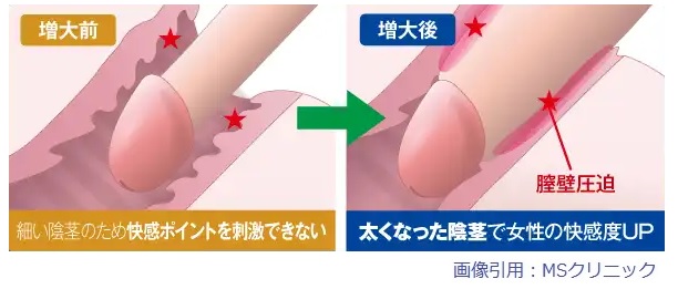 増大手術でセックスの感度アップ